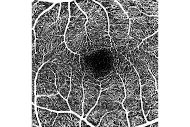 OCT Angiographyの画像